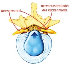 Ursachen und Therapie bei Bandscheibenvorfall und Wirbelgleiten