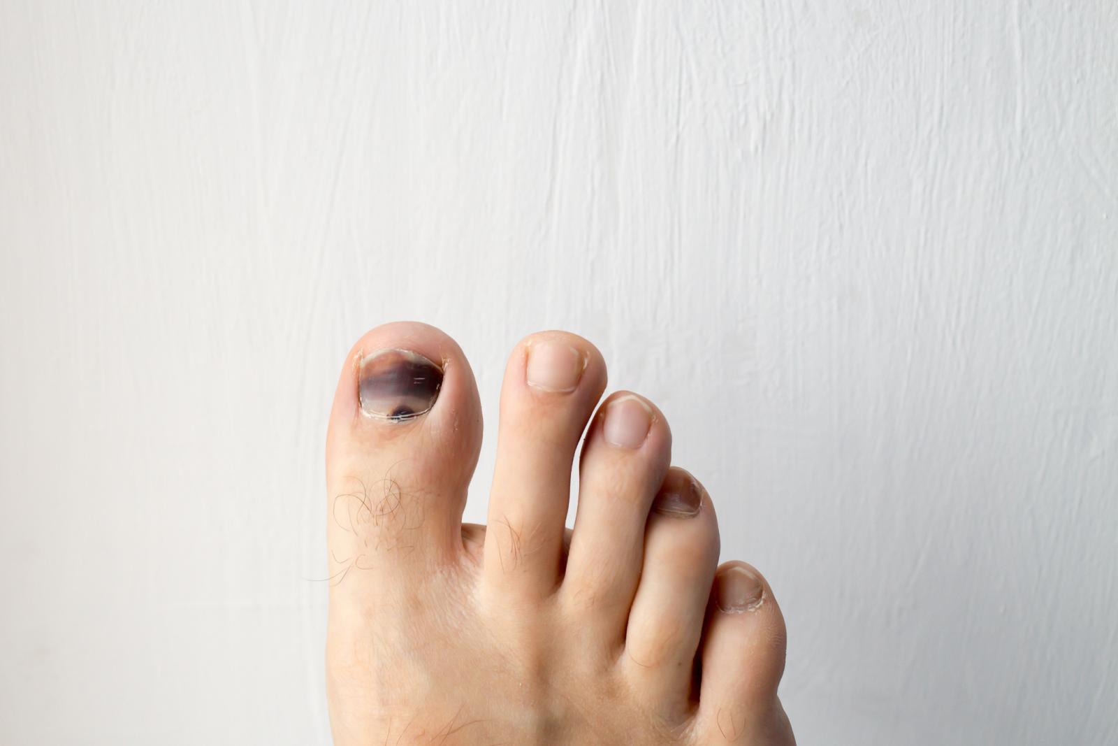 Fußnägel warum immer dicker werden Dicke Zehennägel: