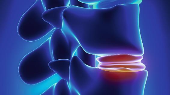 Voll unter Druck: Was tun, wenn es zu einem Bandscheibenvorfall kommt? / Bild: iStock