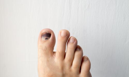 © iStock / avtk Schwarze Zehennägel