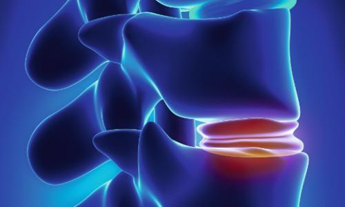 Voll unter Druck: Was tun, wenn es zu einem Bandscheibenvorfall kommt? / Bild: iStock Thumbnail